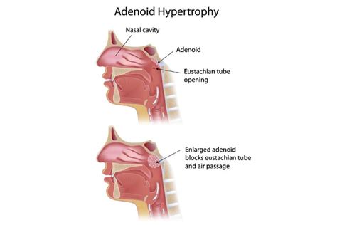 Enlarged Adenoids In Children: Symptoms, Removal & Treatment