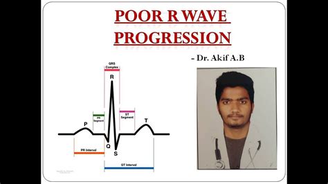 POOR R WAVE PROGRESSION -ECG - YouTube