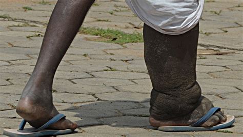 Elephantiasis - Images, Causes, Symptoms, Treatment, Facts | Diseases Pictures