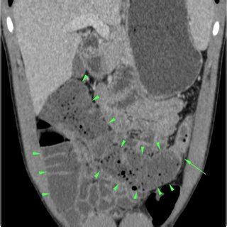 Ileocolic resection showing an edematous terminal ileum with ...