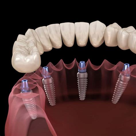 Implant Supported Dentures Hackensack, NJ - Designing Smiles