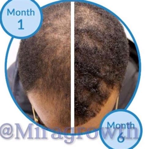 Mens Hair Growth Solution Oil Serum Hair Loss Products Receding ...