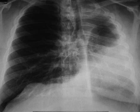 Unilateral Primary Lung Hypoplasia Diagnosed in Adulthood | Respiratory ...