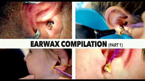 Ear Wax Removal Lower Hutt at Roxanne Bone blog