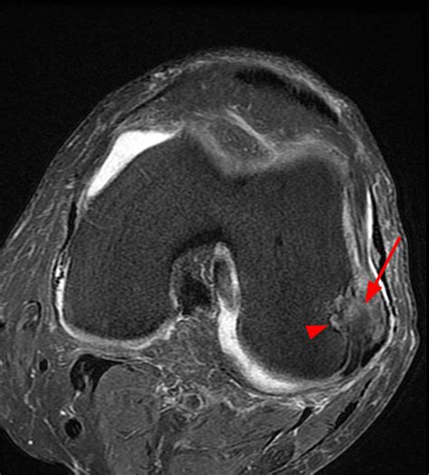 Popliteus Tendon Mri