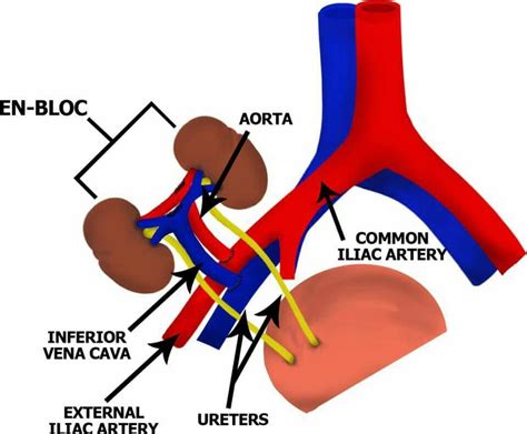 En-bloc kidney transplant | Kidney transplant, Sonography, Kidney