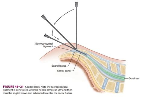 Caudal Anesthesia Technique