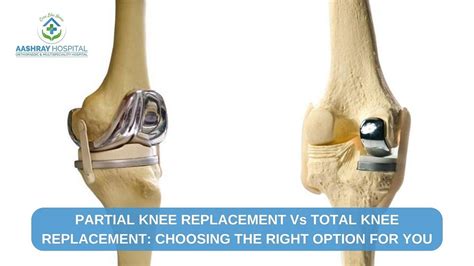 Partial Knee Replacement vs. Total Knee Replacement: Choosing the Right ...