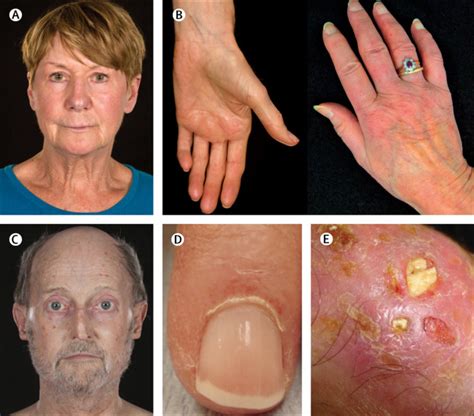 Systemic sclerosis - The Lancet