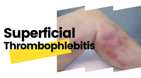 Superficial Thrombophlebitis Information - Vein Solutions