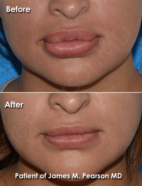 Lip Reduction Photos - Before & After - Dr. James Pearson Facial Plastic Surgery