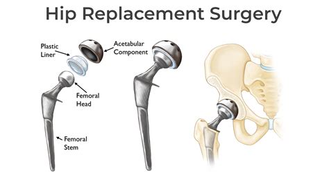 Different Types of Hip Replacement Implants | Capsur Enterprises