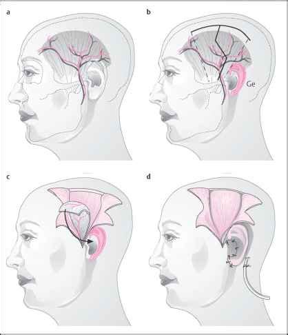 Fan Flap of Parietotemporal Fascia - Facial Plastic Surgery