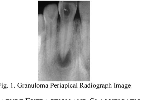 Figure 1 from Granuloma image detection through periapical radiograph by using Gabor wavelet ...