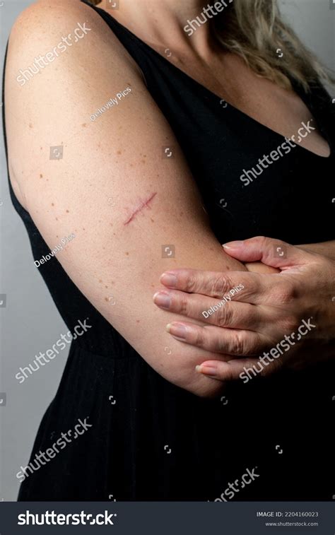 Scar Following Surgery Removal Malignant Melanoma Stock Photo ...