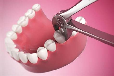 Significado de Sonhar com dente arrancado | Instituto Meempi