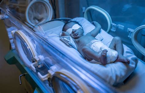 What Is Jaundice in Newborns and How Is It Treated? - Baby Chick