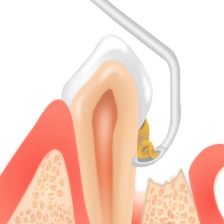 Pocket Reduction Surgery | Baldan Periodontics