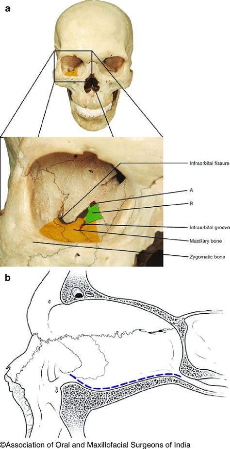 5 The orbital floor in (a) frontal view demonstrating the (A) orbital... | Download Scientific ...