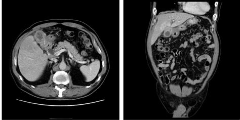 Gallbladder Mass and Diffuse Wall Thickness in an Elderly Patient: is it Definitively a ...