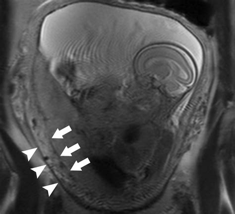 Placenta Accreta: Spectrum of US and MR Imaging Findings | RadioGraphics