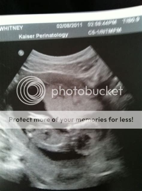 FUNNY ULTRASOUND PICTURES! : ) - BabyCenter