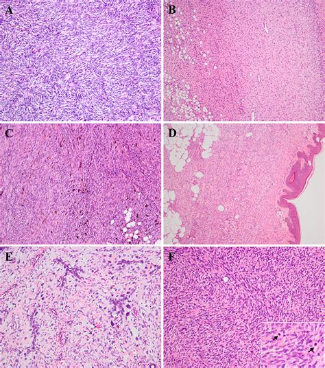 Dermatofibrosarcoma Protuberans Histology