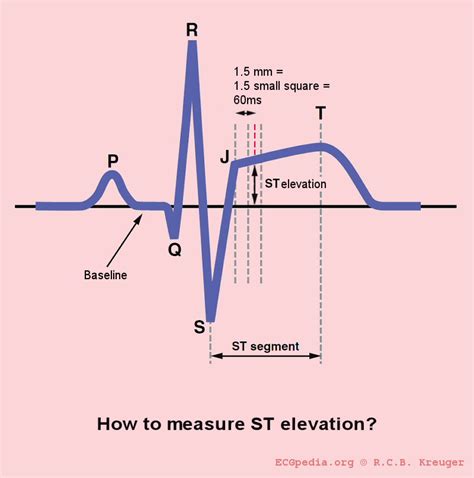 ST interval - wikidoc