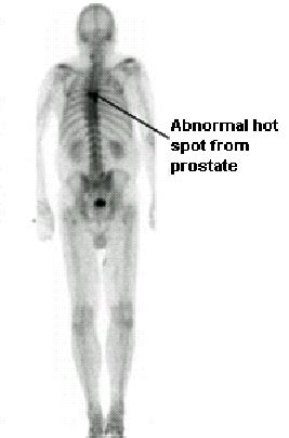 llustrates 2. Abnormal the bone (cancer scan detected) showing bone the... | Download Scientific ...