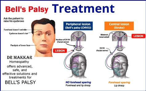 Facial Nerve Palsy Causes Symptoms Treatment Facial Nerve Palsy | Images and Photos finder