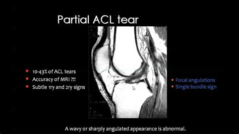 Garrett Berry News: Acl Tear Mri Vs Normal