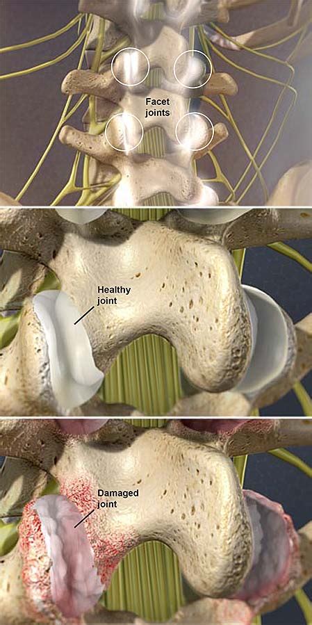 Facet Joint Syndrome | Central Coast Orthopedic Medical Group