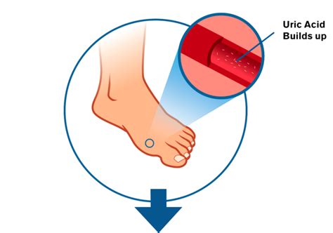 Gout Flare Prevention | Mitigare