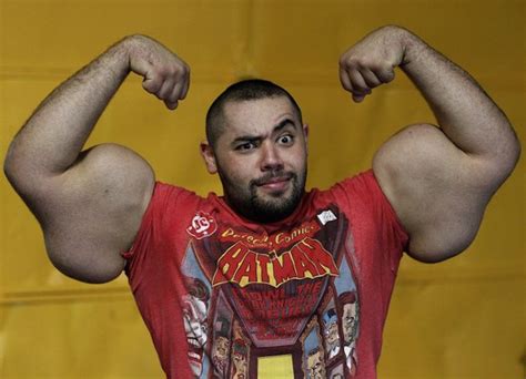 This Guy’s Synthol Arms Exploded Like a Balloon