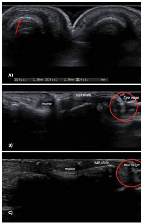 JCM | Free Full-Text | Sonographic Features of Onychopapilloma: A ...