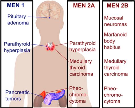 Endocrine- Multiple Endocrine Neoplasia Flashcards | Quizlet