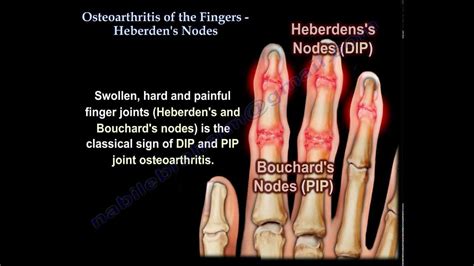 Osteoarthritis Of The Fingers, Heberden's Nodes - Everything You Need To Know - Dr. Nabil ...