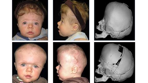 Craniosynostosis Surgery (2022)