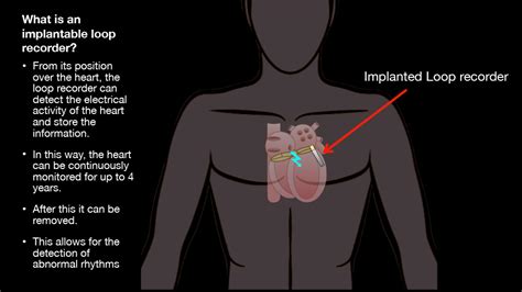 Implantable Loop Recorder (ILR) – Associate Professor Sandeep Prabhu