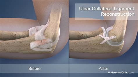 Tommy John Surgery – UnderstandOrtho™