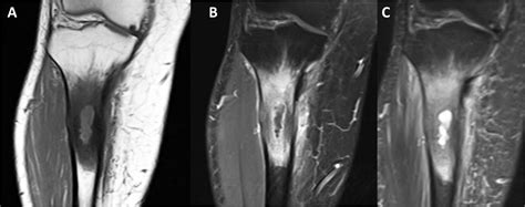 Staphylococcus aureus osteomyelitis causing Brodie’s abscess of the tibia in an adult man | BMJ ...