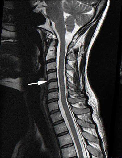 normal cervical spine mri | Mri Scans | Pinterest