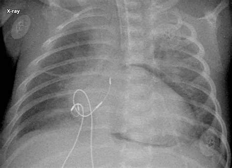 Blunt Cardiac Injury - Cardiovascular - Medbullets Step 2/3