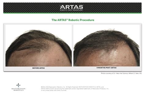 ARTAS Hair Restoration in Dallas | ARTAS iX System in Lewisville