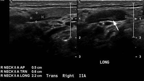 Lymphadenitis and Lymphadenopathy - Internet Book Of MSK Ultrasound