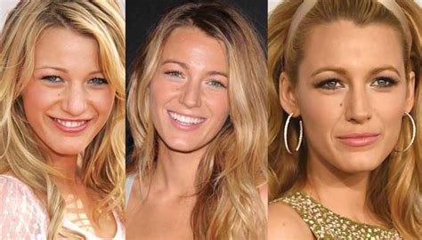 Blake Lively Plastic Surgery Before and After Pictures 2018