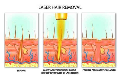 How Long Does It Take Hair To Fall Out After A Laser Hair Removal ...