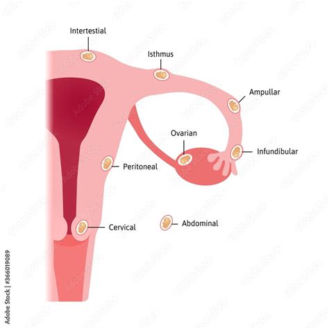 ectopic pregnancy occurs in a fallopian tube. Different types of embryo location. Intertestial ...