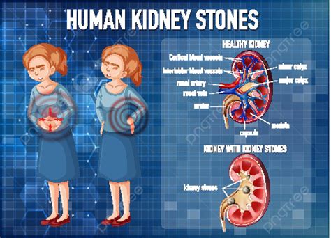 Nephrolith PNG, Vector, PSD, and Clipart With Transparent Background ...