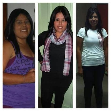 Patient 156788 | Bariatric Surgery Before & After Photos | Tijuana Bariatric Center